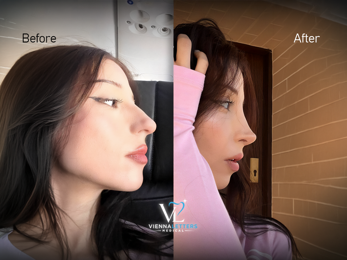 Offene Rhinoplastik