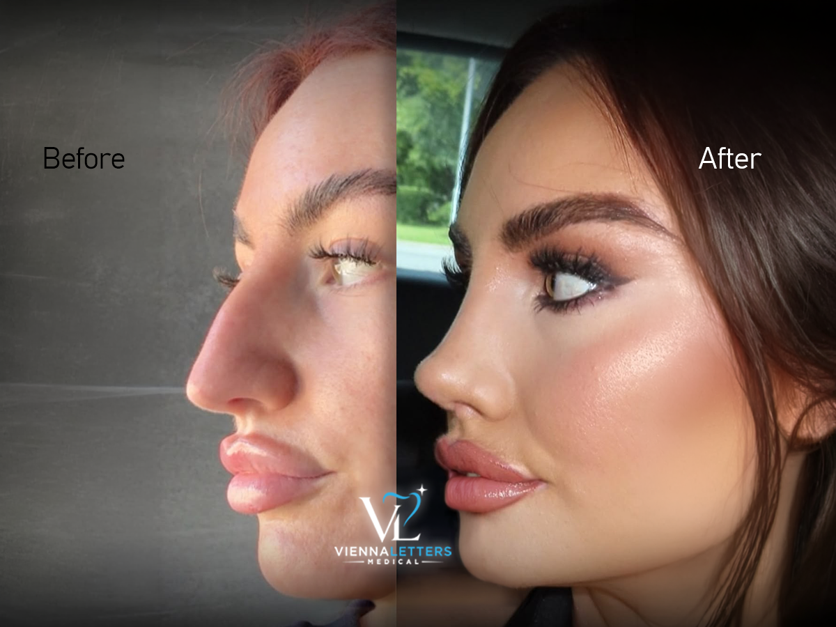 Geschlossene Rhinoplastik