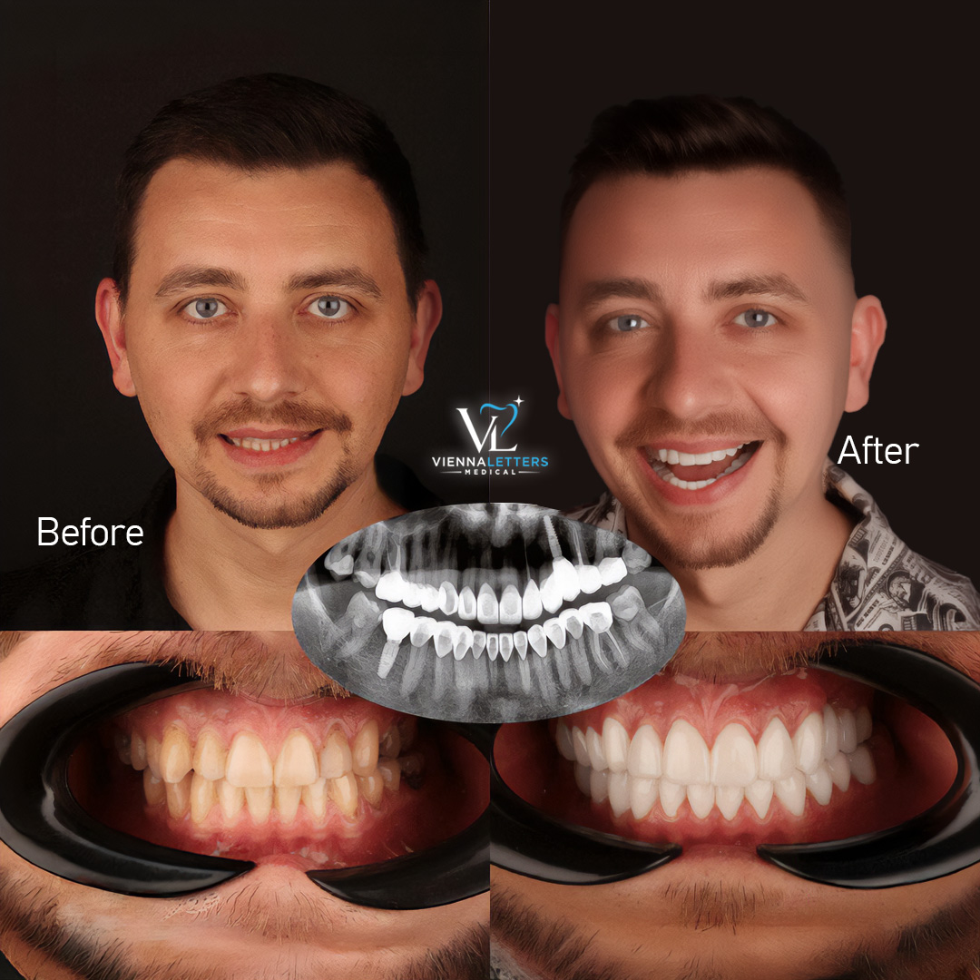 Implantat vorher nachher