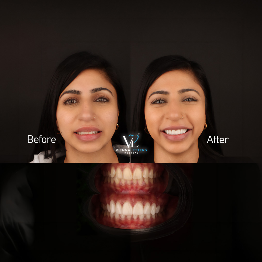 Veneers Smile Design