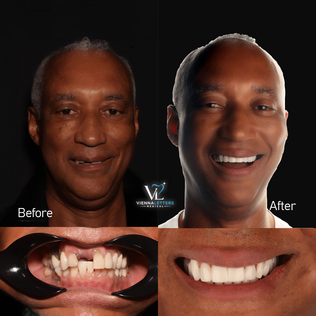 Veneer vorher nachher
