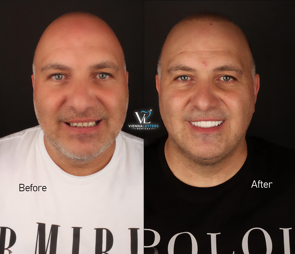 Veneer vorher nachher